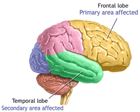 Brain Diagram - Alzheimer's