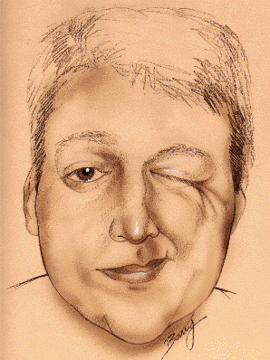 An artist's rendering of hemifacial spasm. This medical condition is frequently treated using Botox®.